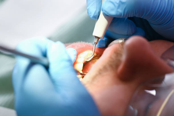 Best Emergency Tooth Extraction in Nashotah, WI